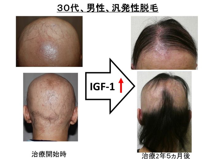 円形脱毛症　病院